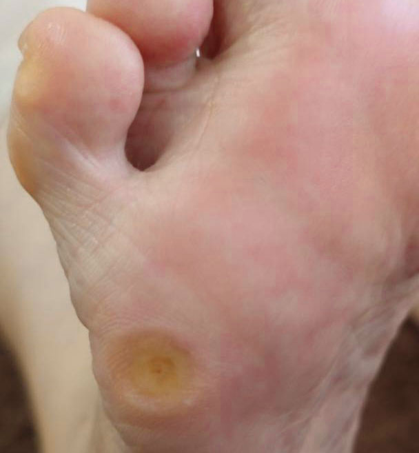 角質ケア施術後